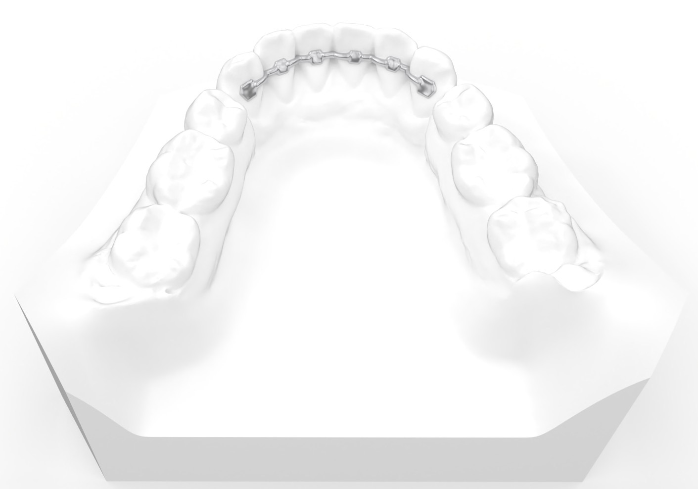3D-printed metal lingual retainer