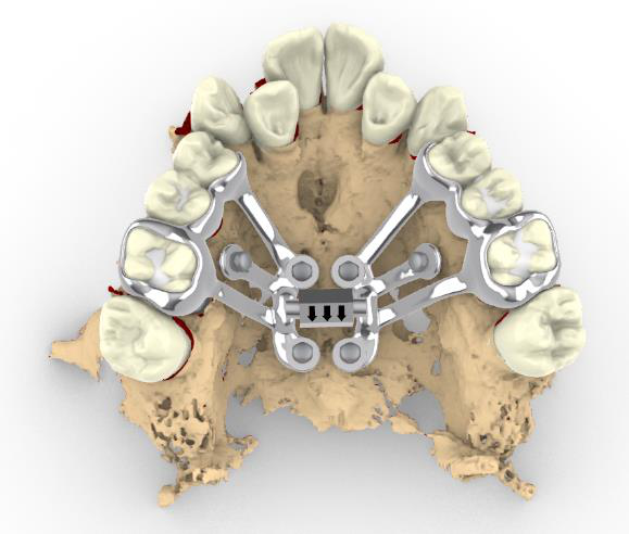 Digitally designed maxillary expander
