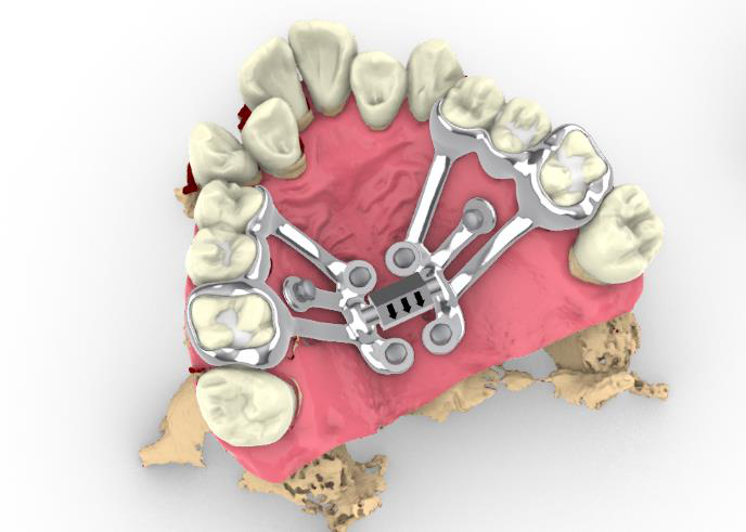 Digitally designed maxillary expander