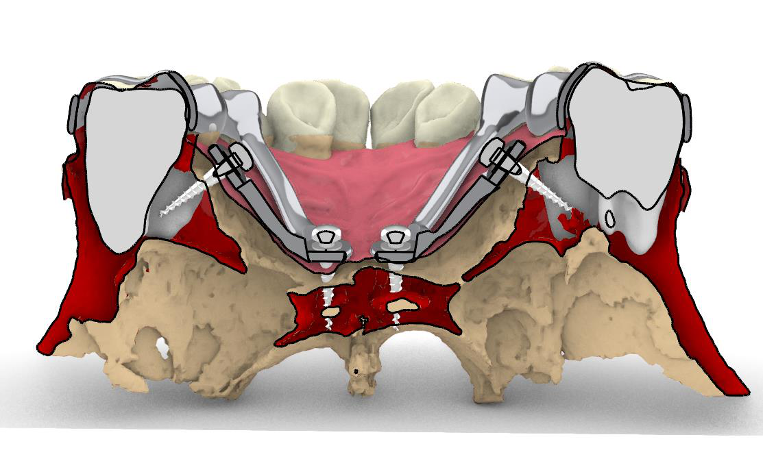 Metal-printed expander, high detail
