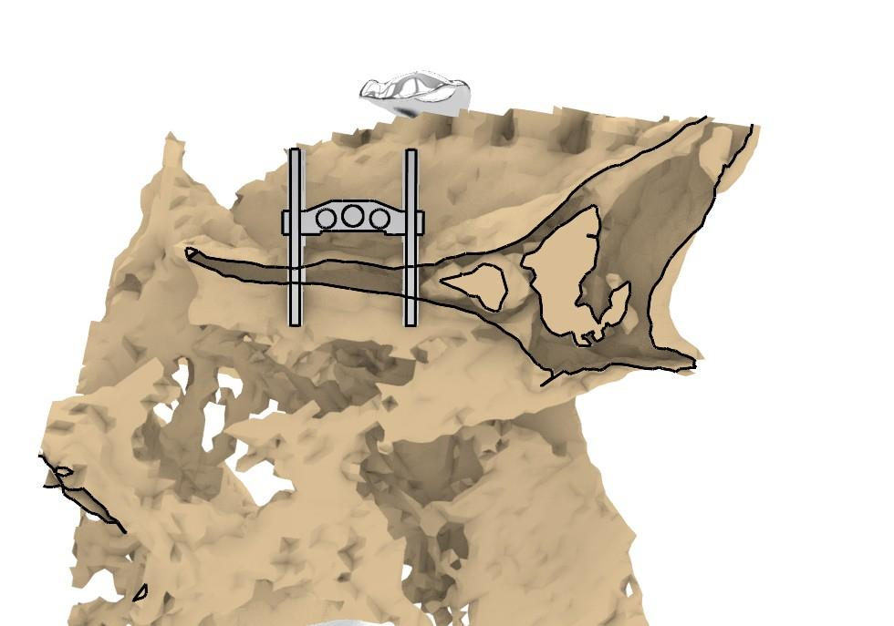 CBCT lateral view — MSE mini-implants engaging the palatal bone