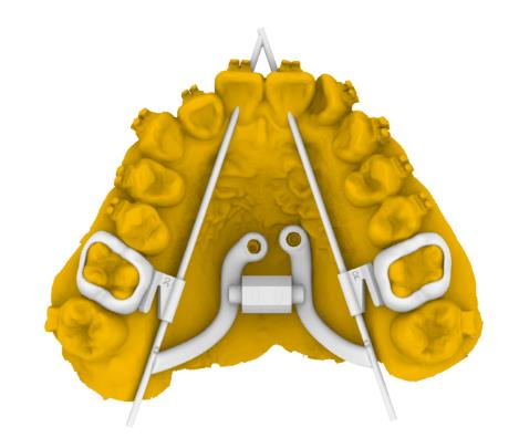 EX Type 2 SuperScrew