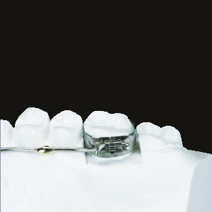 (c) Lingual Arch with Sheath (Straight Usage)