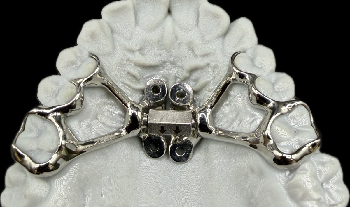 Bone-anchored MSE expander on a maxillary model